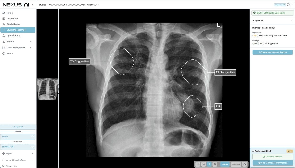 A Nexus AI software interface displaying a chest X-ray with three circled lung areas marked as "TB Suggestive" and "FIR".